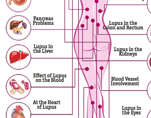 Effects of Lupus